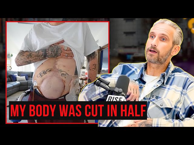 "I Was Cut in Half on Impact" | A Brutal Motorcycle Accident That Left My Intestines Detached
