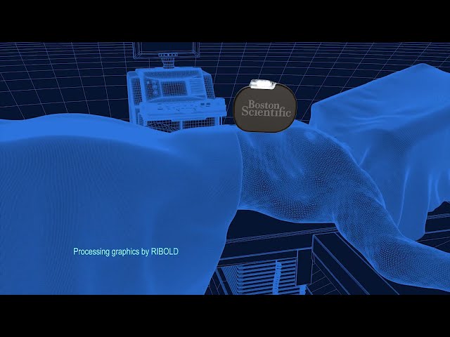 S-ICD Implantation
