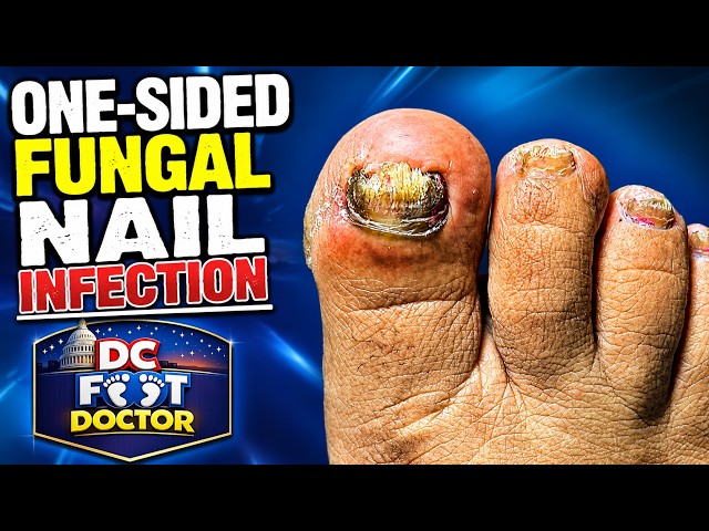 One-Sided Fungal Nail Infection