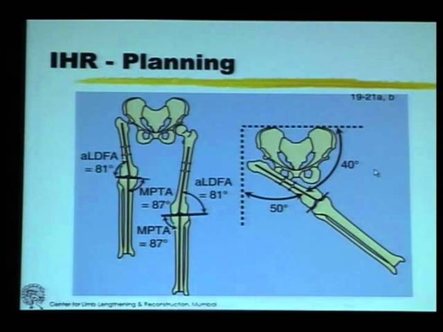 IHR - Ilizarov Hip Reconstruction