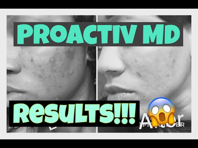 Does ProActivMD Work? My Results!!