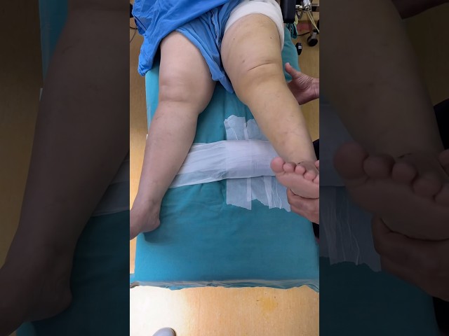 Knock Knees: The 10-Second Test Before Knee Replacement #drpankajwalecha
