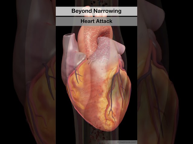 Hidden Disease - Coronary Artery Disease (CAD)