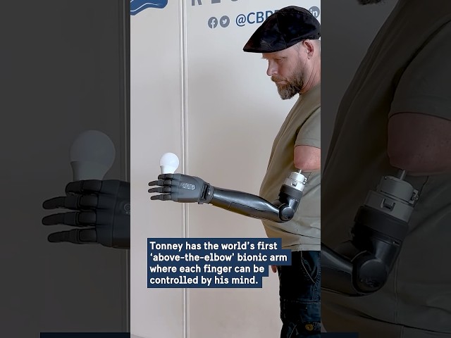 The world's first above-the-elbow bionic arm! #sweden #medtech #innovation #bionics