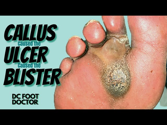 Callus Caused An Ulcer Which Caused A Blister: Urgent Diabetic Foot Care