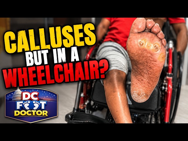 Calluses But In A Wheelchair?