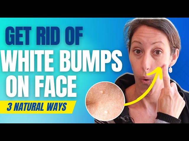 How to Get Rid of Mila | Natural Treatment for Milia - Pesky White Bumps on Your Face