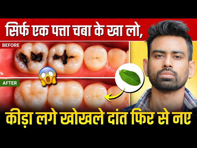 एक बार में दांत का कीड़ा और दर्द बाहर निकालने का बेहतरीन उपाय - Teeth Cavity | Fit Tuber Hindi