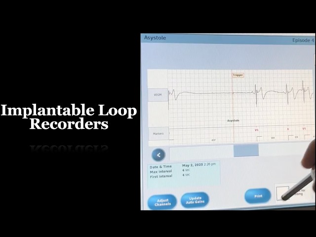 Merlin PCS Demo - Implantable Loop Recorder | Part 2