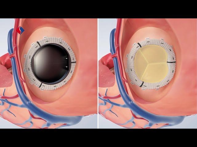 Mitral valve regurgitation surgery | Medical animation