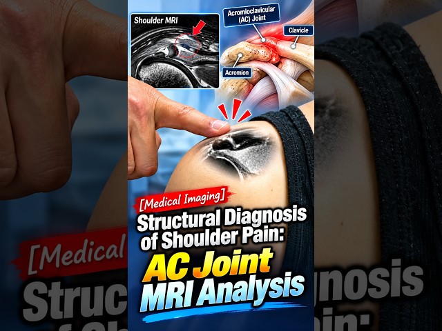 [Medical Imaging] Anatomical Structure of the Acromioclavicular (AC) Joint
