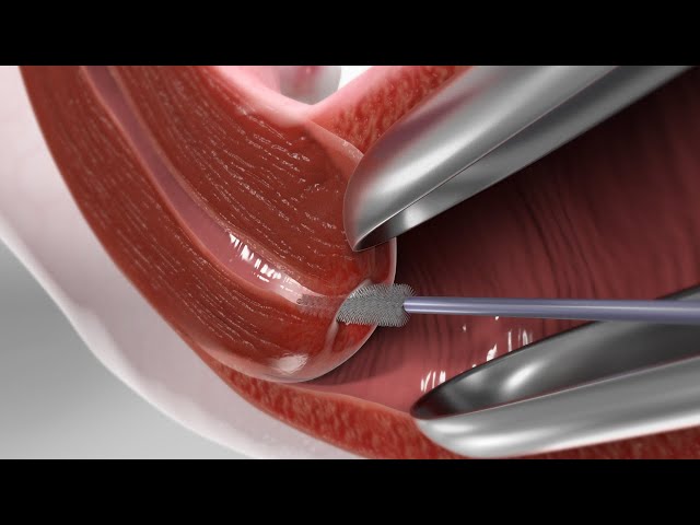 Pap Test (3D Animation)