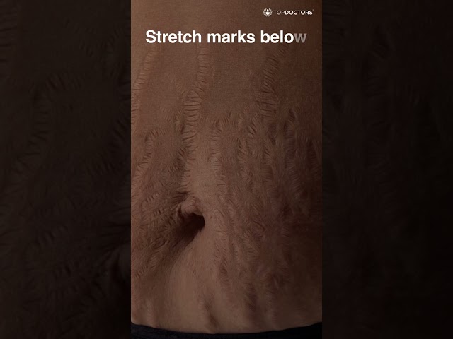 Tummy Tuck Explained 🩺 | Mini vs Full Abdominoplasty, What You Need to Know