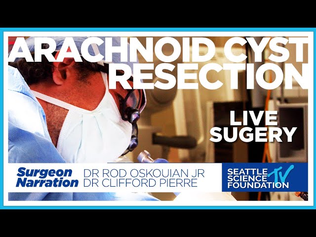 Arachnoid Cyst Resection - Rod J. Oskouian JR. M.D. - Narrated by Clifford Pierre, M.D.