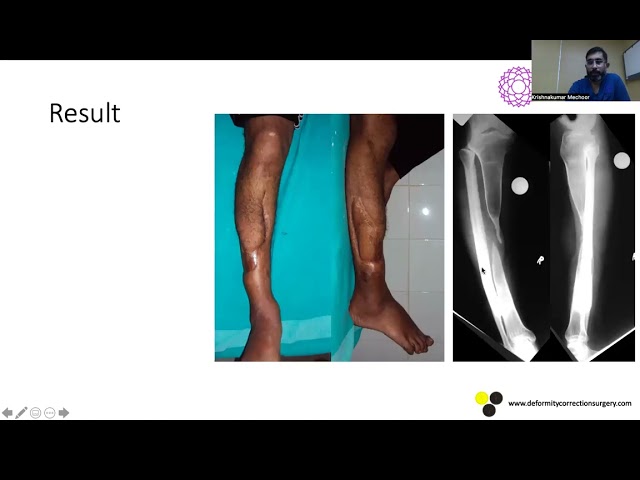 LRS Use & Abuse  - Dr Krishnakumar Mechoor