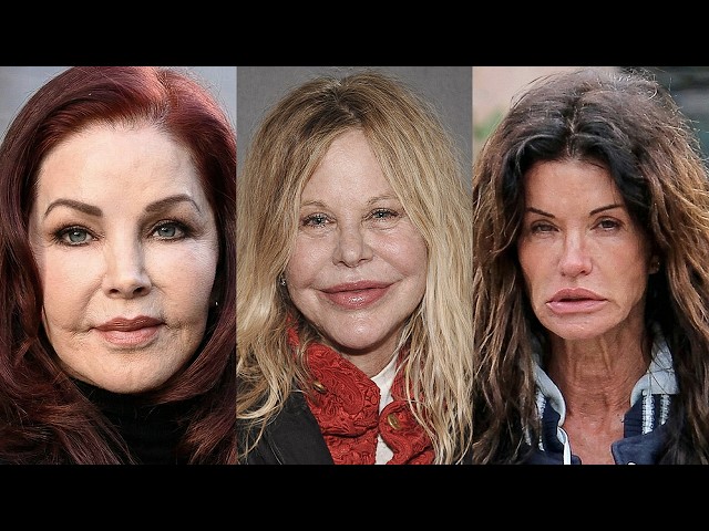 15 Classic Beauties Suffering From Pillow Face | Before and After Photos