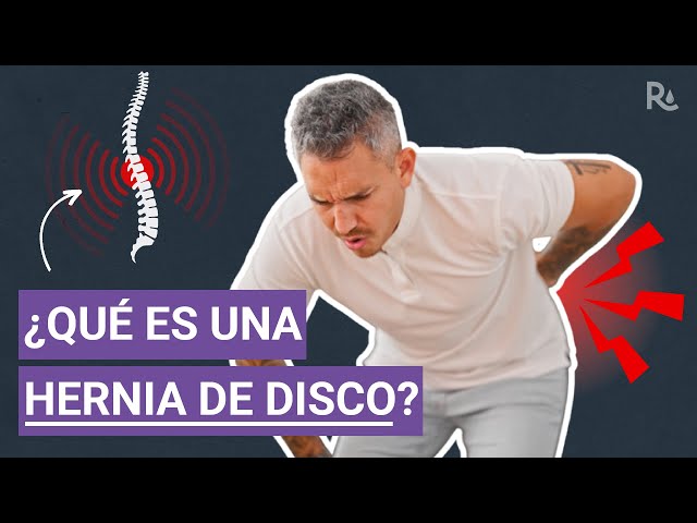 ¿Qué es una hernia de disco? ¿Causa dolor en la espalda baja?