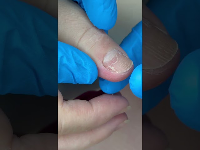 Onycholysis Therapy🆘ASMR