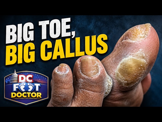 Big Toe, Big Callus