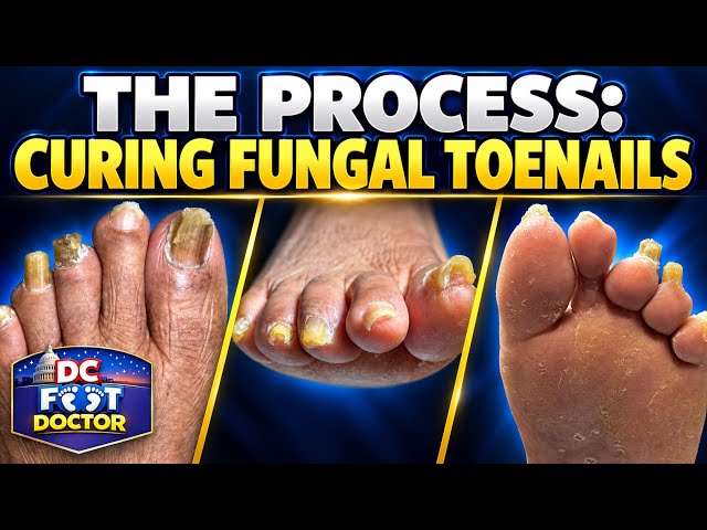 The Process: Curing Fungal Toenails