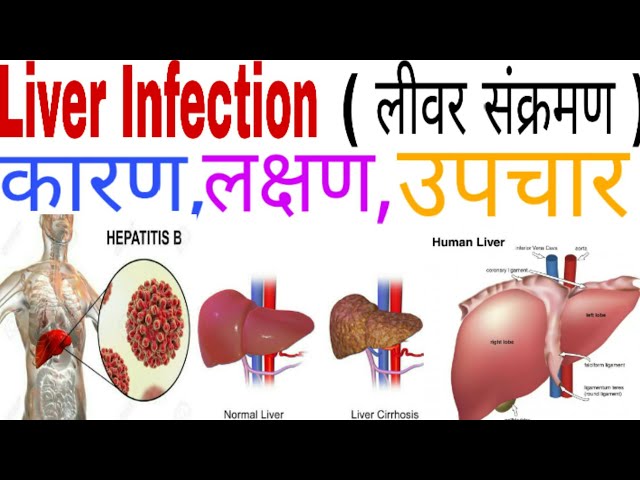 Liver Infection in hindi | लीवर संक्रमण के कारण लक्षण व उपचार |