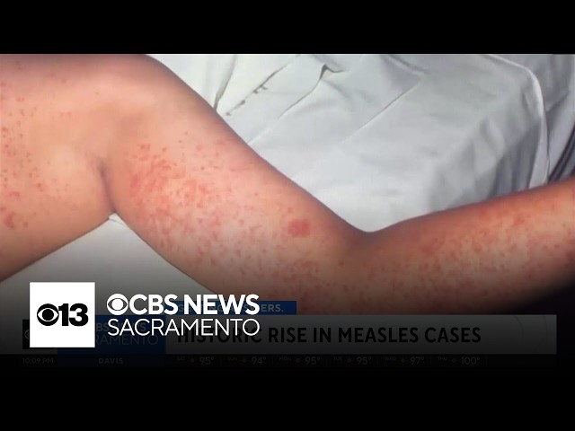 Measles cases surge in California as doctors warn of highly contagious virus