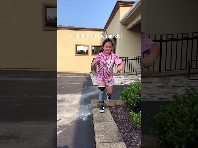 Annabelle’s Confident First Steps with BK Prosthetic Leg