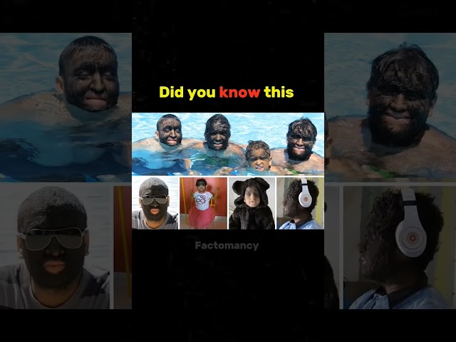 😱 Did you know this #amazingfacts #viralshorts #shortsvideo #didyouknow #hypertrichosis