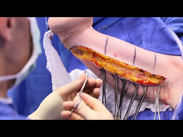 (Surgical Video) Female Patient Gets Skinny Arms with a Brachioplasty