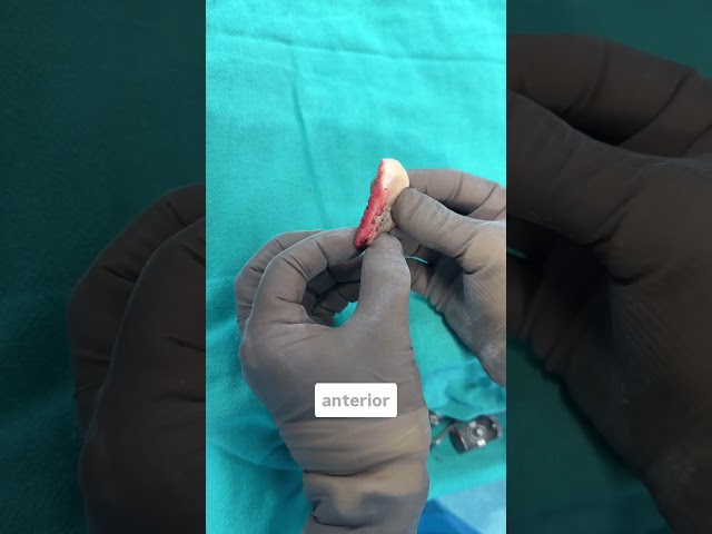 Tibial biscuit in partial knee replacement (UKR) surgery #partialkneereplacement