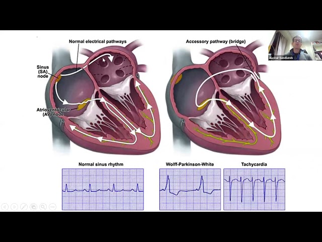ECG lecture 4 narrow complex tachycardias