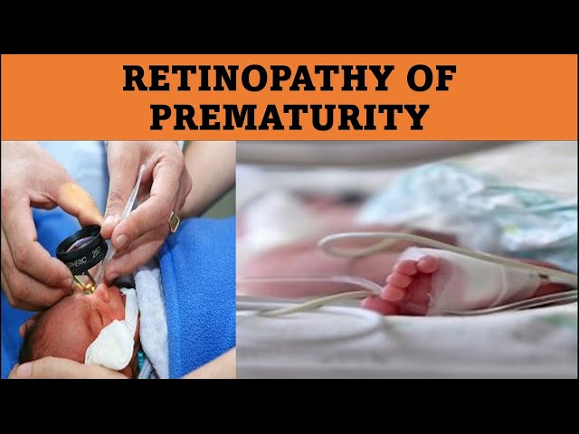What Causes ROP | Retinopathy of prematurity