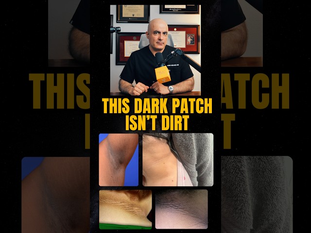 That Dark Patch on Your Neck Isn’t Dirt | PCOS & Insulin Resistance