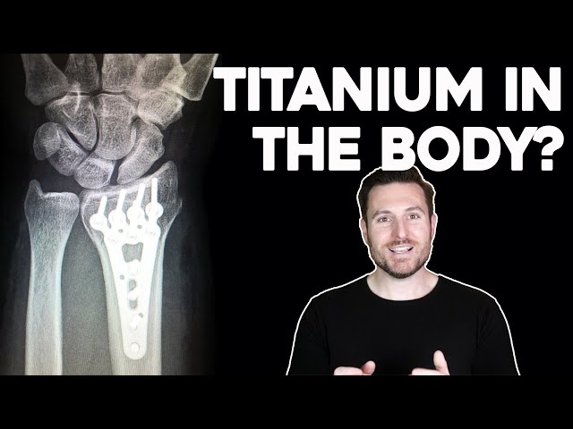 Why Do Surgeons Use Titanium in the Body? | Corporis #shorts