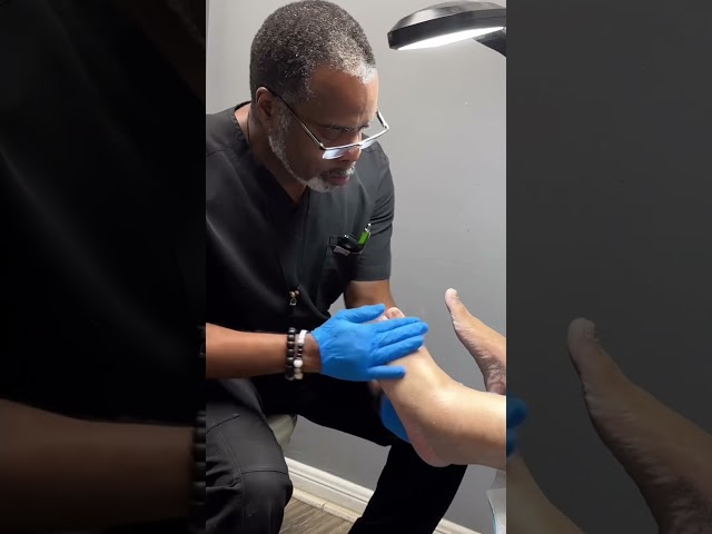 Diabetic with athlete’s foot #podiatry #athletesfoottreatment #diabetescare