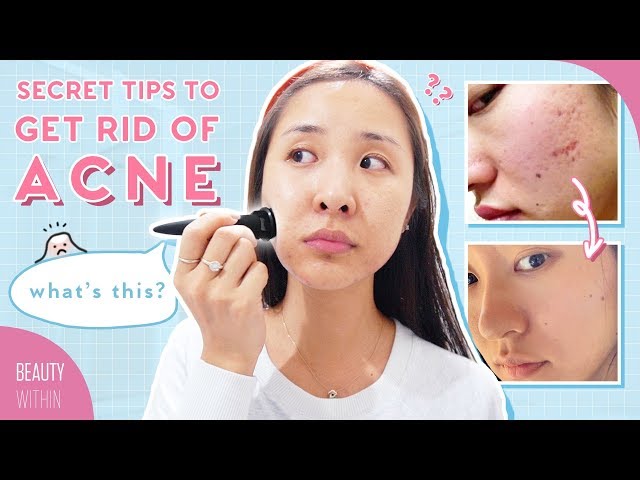 Banish CEO's Acne Story on How to Clear Hormonal Acne, Scarring & Hyperpigmentation (ft. Daisy Jing)