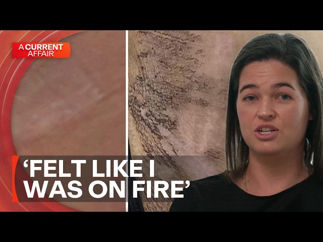 Mother claims she was left with second-degree burns after laser hair removal | A Current Affair