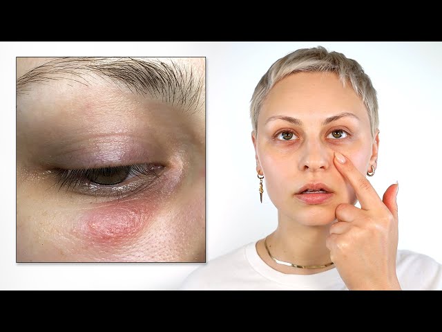 Before you get filler..we should talk...