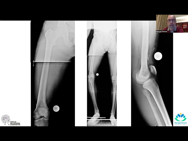 Planning & Execution of Deformity correction with Tabplan3D