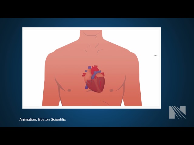 What is a Pacemaker?