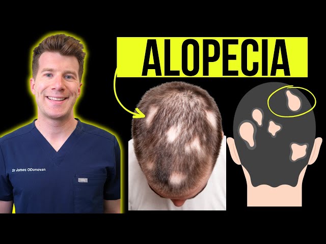 Doctor explains Alopecia Areata (aka patchy or total hair loss) - Signs, Symptoms, Treatment & more