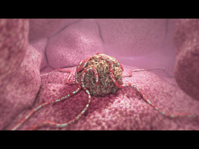360° Tumor Death Animation (demo)