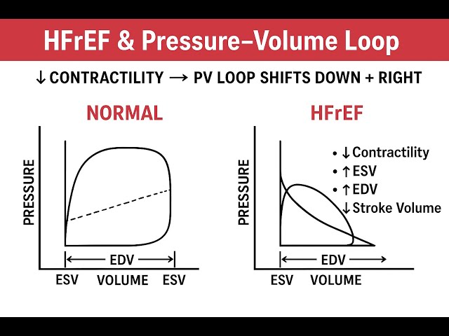 HF Part 1 :  HFrEF, HFpEF //  USMLE STEP 1 podcast