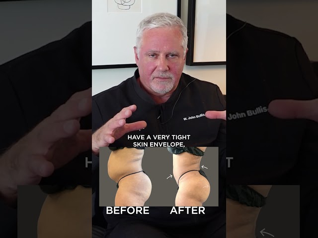 What is a Brazilian Butt Lift (BBL)?