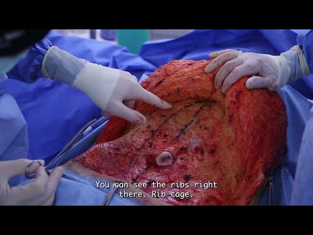 Graphic Surgical Video - Tummy Tuck Procedure by Beverly Hills Plastic Surgeon