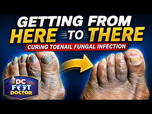 Getting From Here To There Curing Fungal Toenail Infection