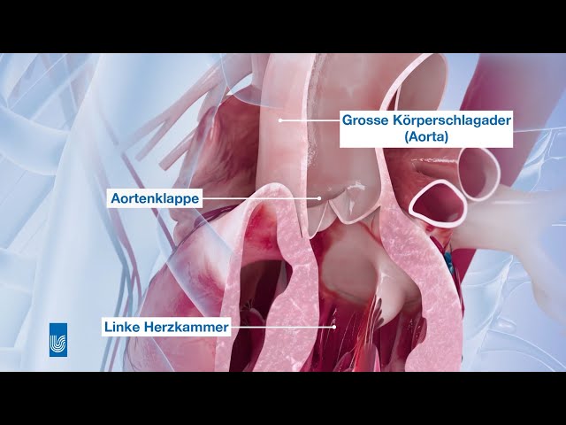 Heart valve surgery | Medical animation