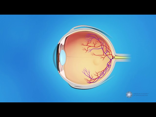 Laser Surgery for ROP