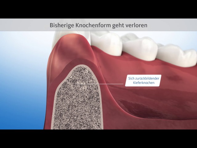 Bone Grafting After Tooth Loss (Socket and Ridge Preservation)