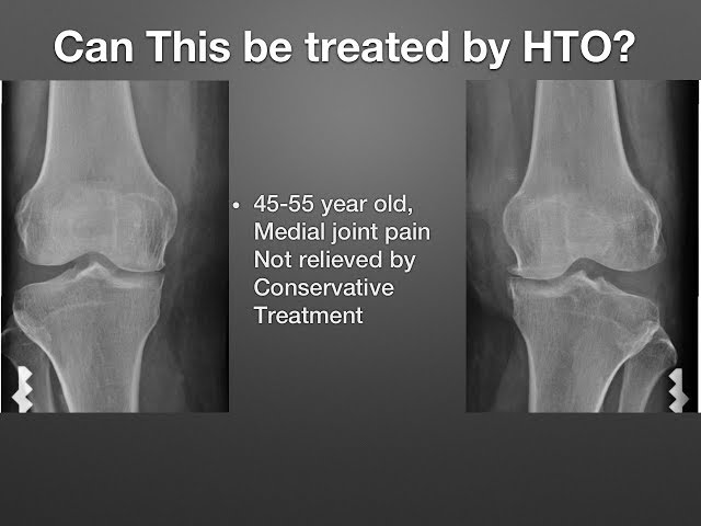 High Tibial Osteotomy - Misconceptions & Planning